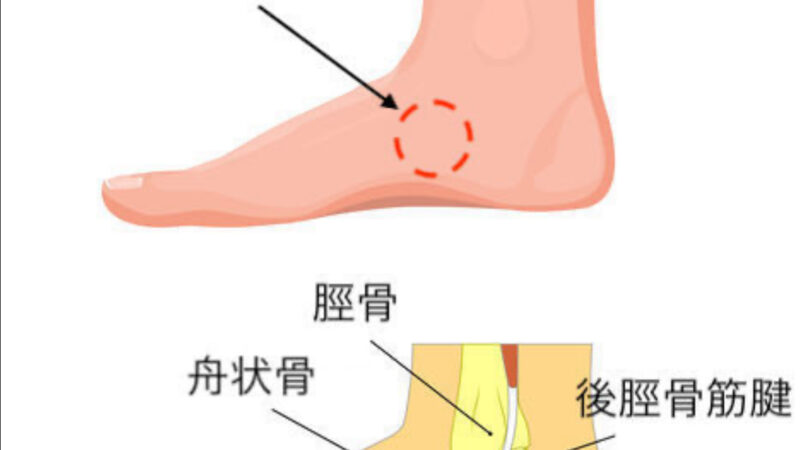 有痛性外脛骨とは