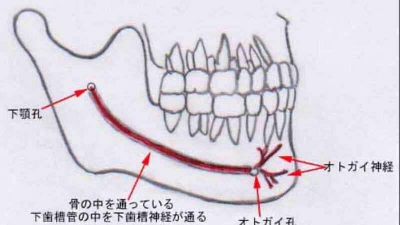 下歯槽神経麻痺とは？