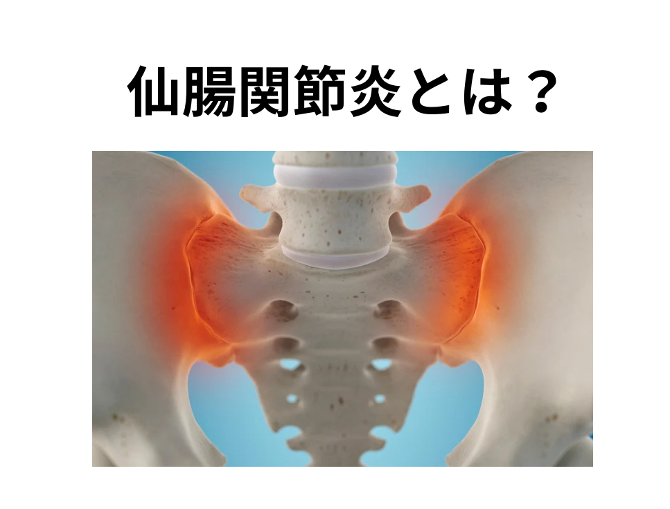 仙腸関節炎とは?